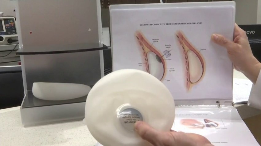 Reconstrucción del seno con implantes: un alivio después del cáncer