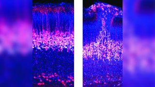 Neuronas piramidales de la capa cinco del córtex en ratones normales (izquierda) comparados con ratones con el gen del autismo eliminado (derecha), mostrando un parche de corteza desorganizada.