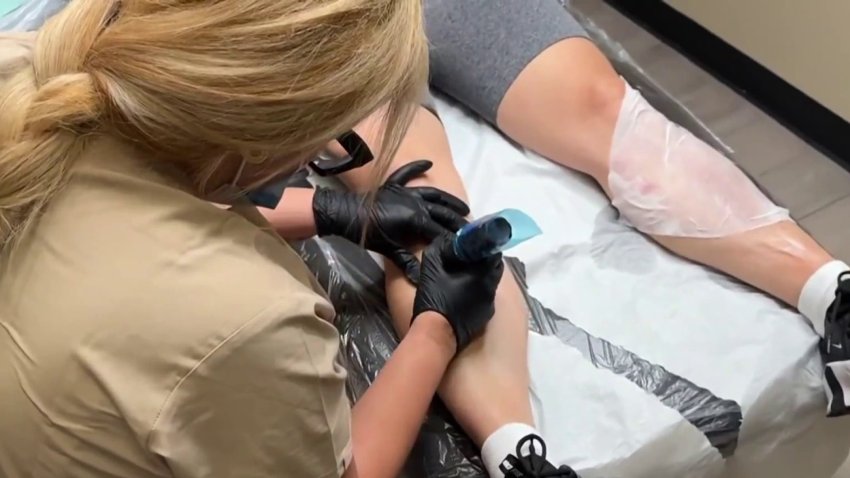 Tatuajes paramédicos: tecnología llega al Valle Central para cubrir cicatrices