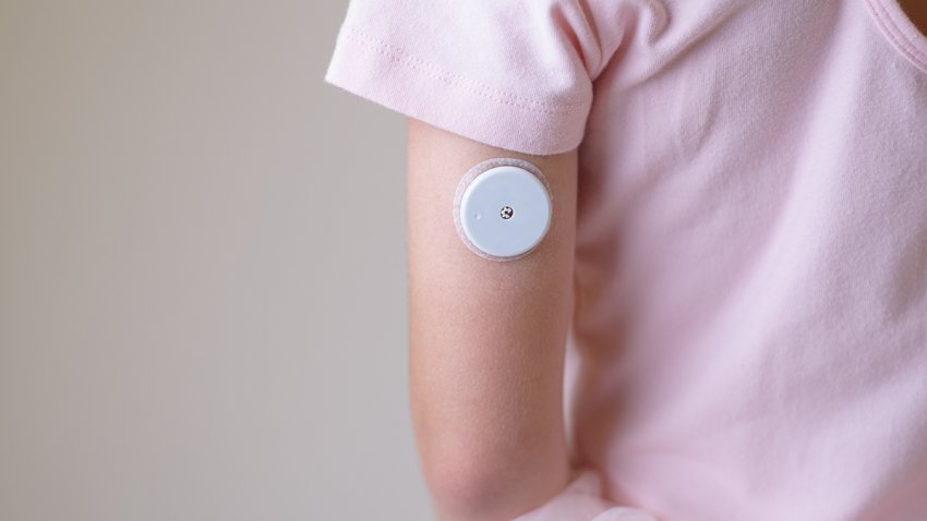 Blood glucose sensor on the arm of a child. Sensor for remote measurement of blood glucose levels using NFC technology on a mobile phone or reader.