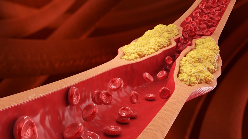 High Blood Cholesterol, Thickened Arteries and Veins, Red Blood Cells, 3d illustration.
